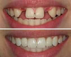 Dental Restoration Before and After Photo