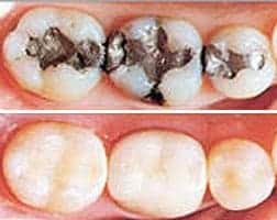 Dental Fillings Before & After