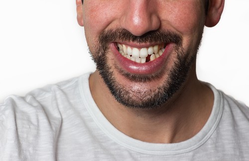 man with missing tooth